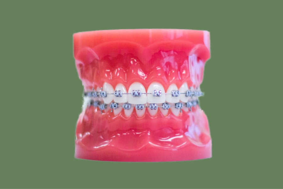 metal braces photo