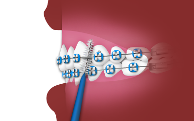 Oral Hygiene - Interdental Toothbrush