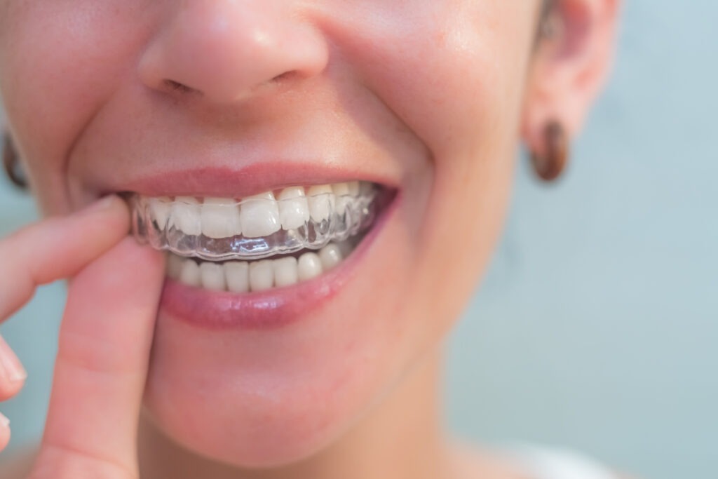 A woman inserting clear aligners